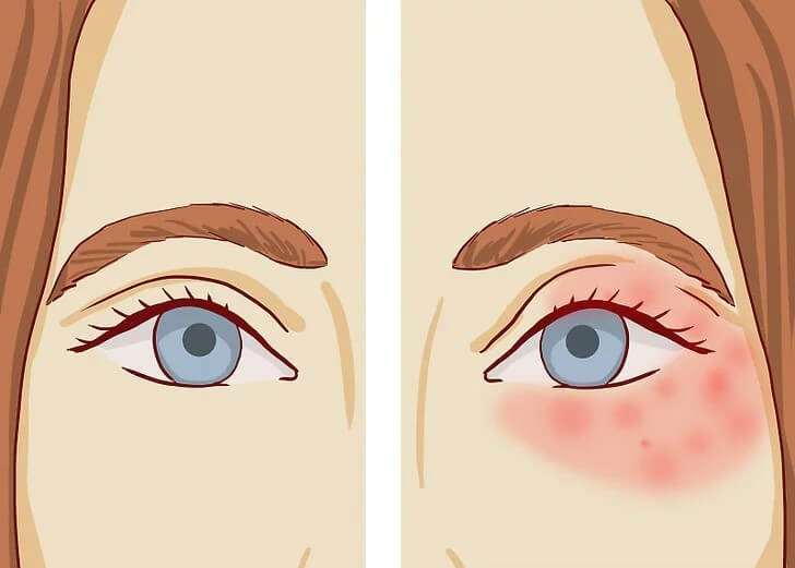 Các phương pháp điều trị bệnh chàm quanh mắt