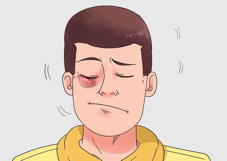 Cách điều trị mắt bầm tím hiệu quả