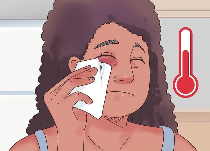 Cách điều trị mắt bầm tím hiệu quả