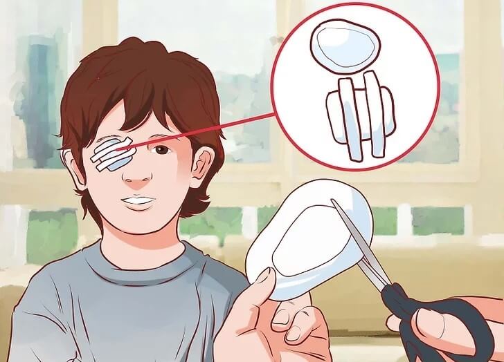 Cách điều trị nhược thị (mắt lười) 