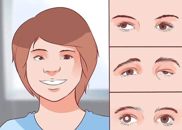 Cách điều trị nhược thị (mắt lười)