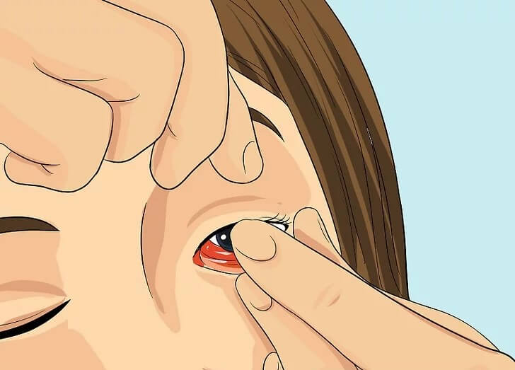Cách khắc phục tình trạng khô mắt khi đeo kính áp tròng