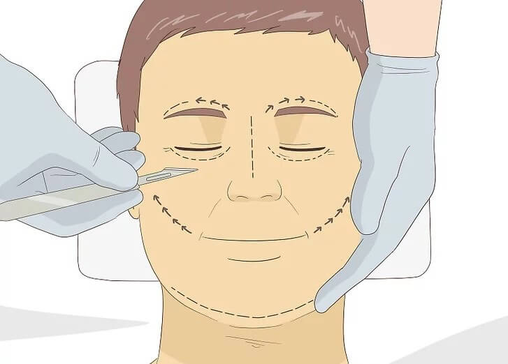 Cách làm căng da mặt không phẫu thuật