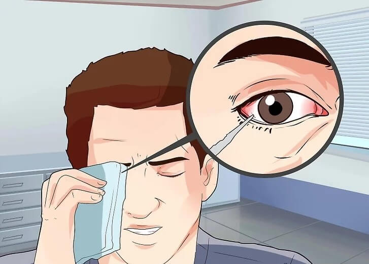 Cách loại bỏ dị vật ra khỏi mắt an toàn