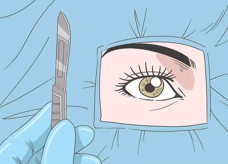 Cách trị bệnh mắt tuyến giáp hiệu quả