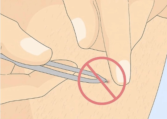 Hướng dẫn cách loại bỏ lông mọc ngược sau khi cạo lông tại nhà