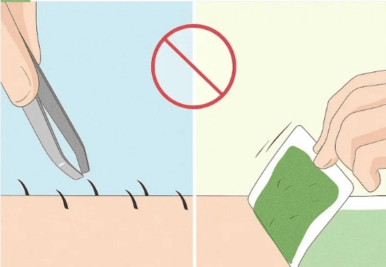 Những điều cần chuẩn bị trước và sau khi triệt lông bằng laser 